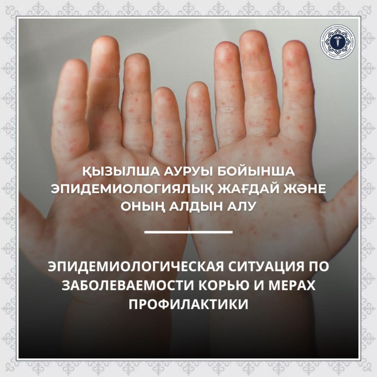 Қызылша ауруы бойынша эпидемиологиялық жағдай және оның алдын алу