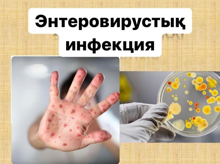 Энтеровирустар мен коксакки: жазғы инфекциялардан қалай қорғануға болады